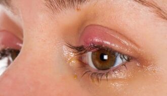 Eye problems
