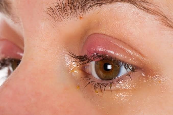 Eye problems