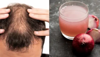 Hair fall