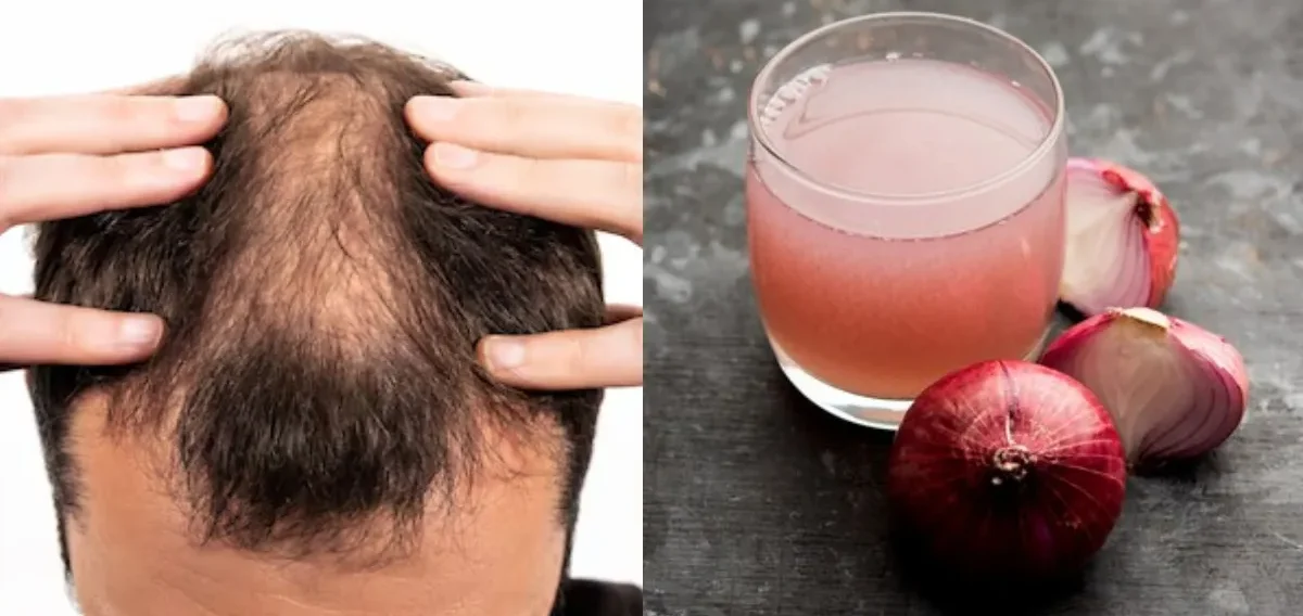 Hair fall